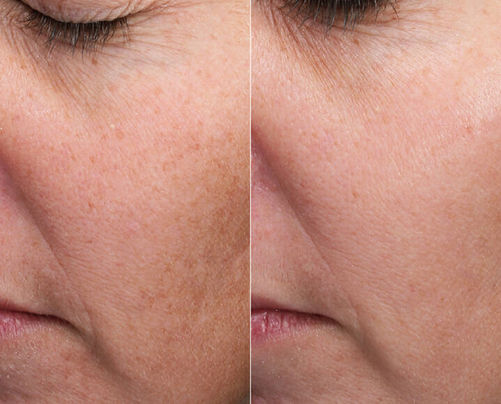 laser treatment before and after